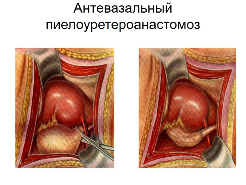 Антевазальный пиелоуретероанастомоз